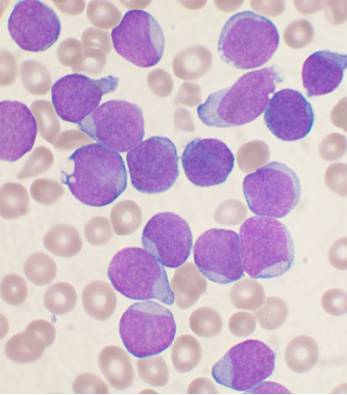 acute_leukemia-medlem-project_medlemproject