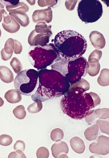 faggot_cell_in_acute-promyelocytic-leukemia-medlem-project_leukemia_treatment