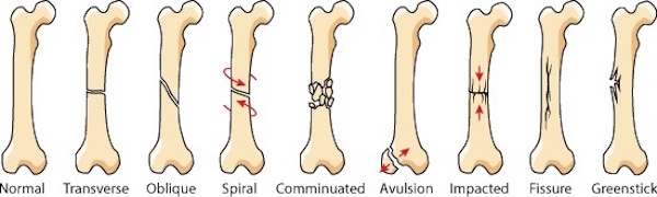 Amniotic fluid reverses ageing bones-Experimenting on mice to prove the efficiency of this potential treatment-bone fractures