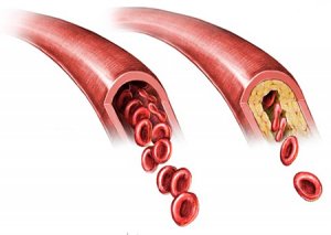 Cerebral-atherosclerosis-measure of aging long long life transhumanism longevity anti aging