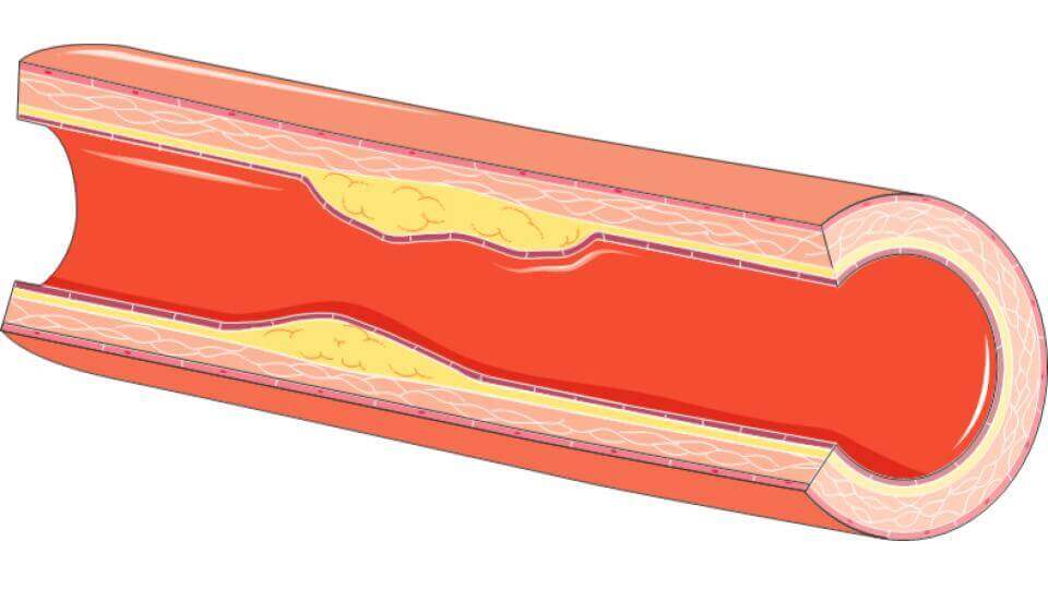 cardiovascular diseases-Long-Long-Life-transhumanism health longevity aging