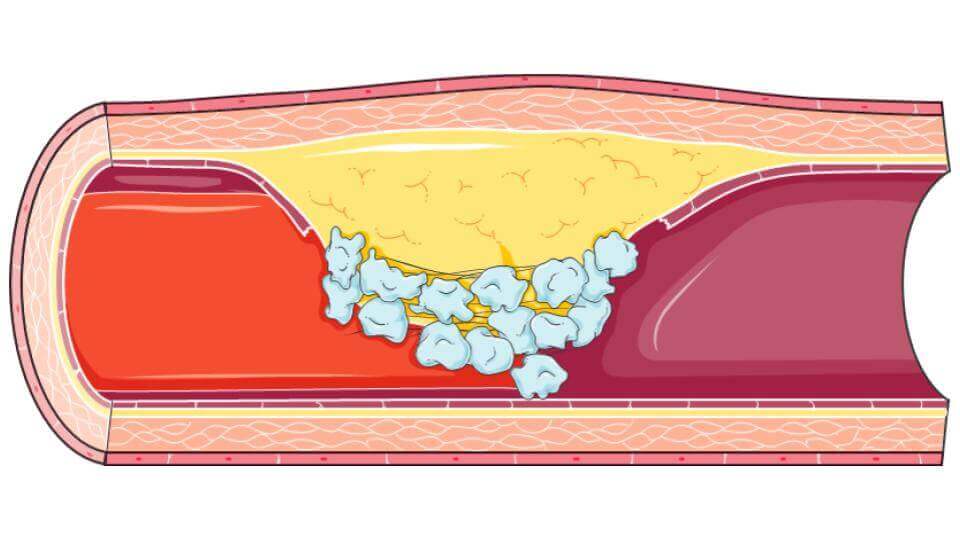 cardiovascular diseases-Long-Long-Life-transhumanism health longevity aging